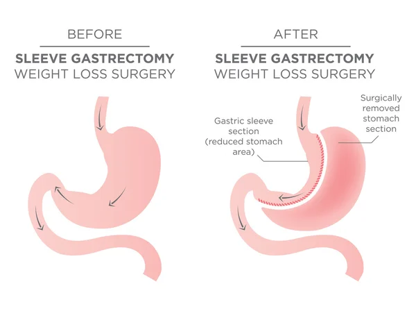 What is Sleeve Gastrectomy?