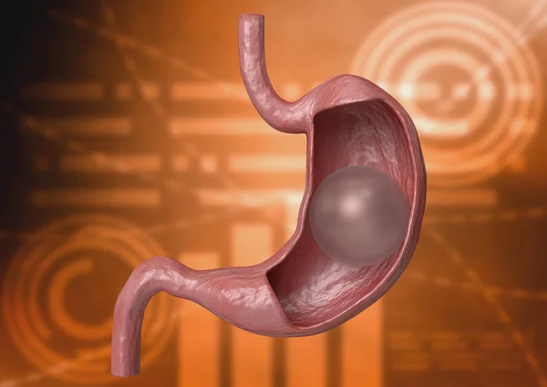 What is the Elipse Swallowable Gastric Balloon in Turkey?