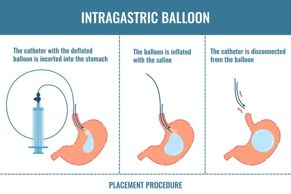 What is an Intragastric Balloon in Turkey?